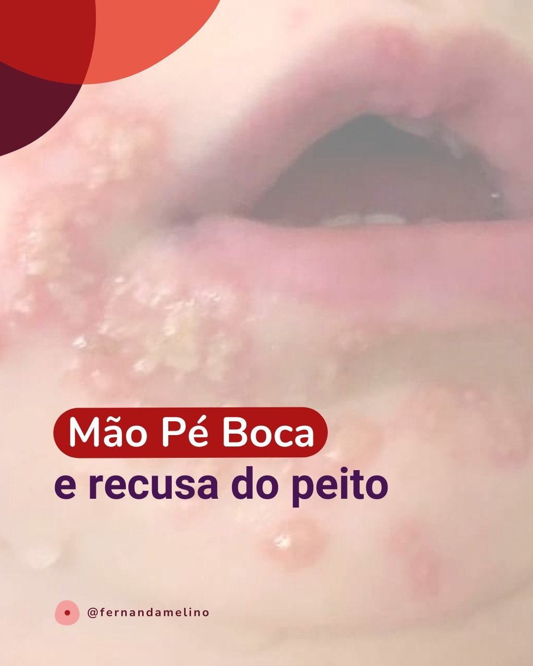 Meu bebê está com "mão-pé-boca" e não quer comer e mamar